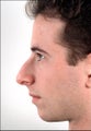 Rhinoplasty and Chin Implant