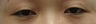 Bilateral Asian Eyelid Surgery