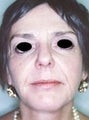 Female patient who underwent liposuction