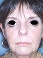 Female patient who underwent liposuction