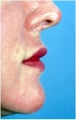 Lip Augmentatin with Testylane