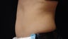 Coolsculpting Abdomen