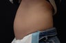 Coolsculpting Abdomen