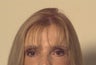 CO2 Laser Resurfacing