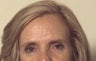 CO2 Laser Resurfacing