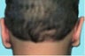 Ear Surgery for Men