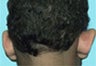 Ear Surgery for Men