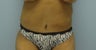 28 Year Old Female Underwent Full Abdominoplasty (Tummy Tuck) After Massive Weight Loss.