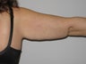 38 Year Old Woman with Arm Lift