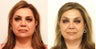 Fat transfer with a facelift