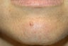 Mole Removal