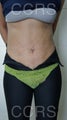 35 yr. old female for body contouring