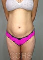 35 yr. old female for body contouring