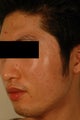 Pore Size Reduction/Acne Scars
