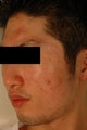 Pore Size Reduction/Acne Scars