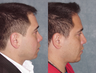Revision Rhinoplasty
