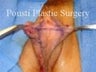 Labial Reduction
