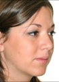 Rhinoplasty