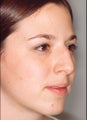 Rhinoplasty
