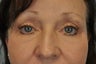 Eyelie Fat Removal