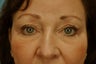 Eyelie Fat Removal