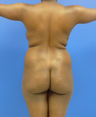 Brazilian Butt lift via fat transfer
