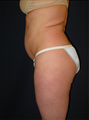 Butt Augmentation