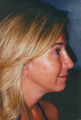 Chin Augmentation