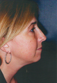 Chin Augmentation