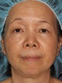 50 year old Asian female treated for brown spots and age spots