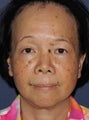 50 year old Asian female treated for brown spots and age spots