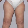 62 year old woman has Thigh Lift