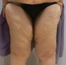 62 year old woman has Thigh Lift