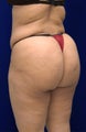 Brazilian Butt Lift