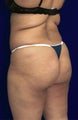 Brazilian Butt Lift
