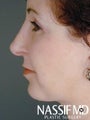 Female Primary Rhinoplasty