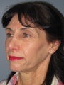 Chin Surgery on 65-year-old
