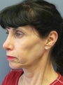 Chin Surgery on 65-year-old