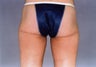 Thigh Lift