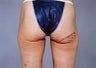 Thigh Lift
