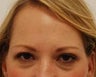 Caucasian Female Underwent Botox