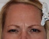 Caucasian Female Underwent Botox