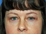 upper blepharoplasty