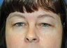 upper blepharoplasty