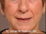 Injectable Filler Treatment