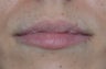Lip Injection with Juvederm