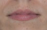 Lip Injection with Juvederm