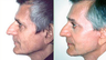 Endoscopic Forehead Lift Improves Brows and Eyelids