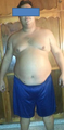 26 Year old male Sever Obesity