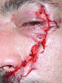 Male Chainsaw Injury Reconstruction